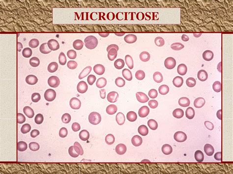 microcitose e câncer